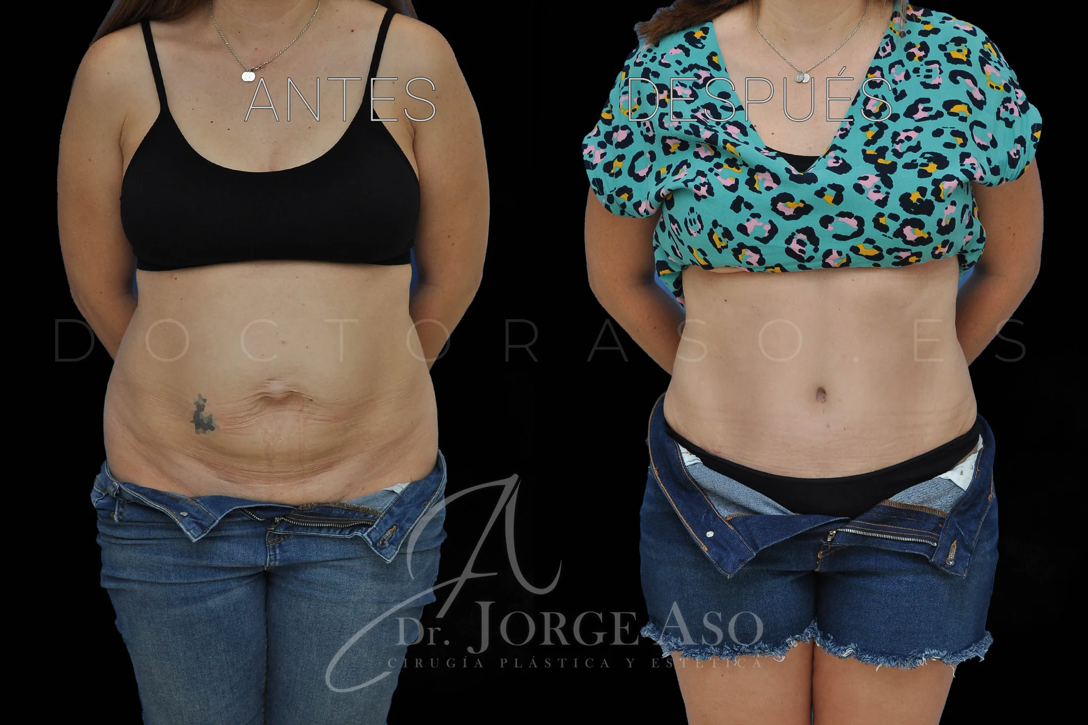 lipoabdominoplastia antes y después con reparación de diástasis de rectos vista frontal
