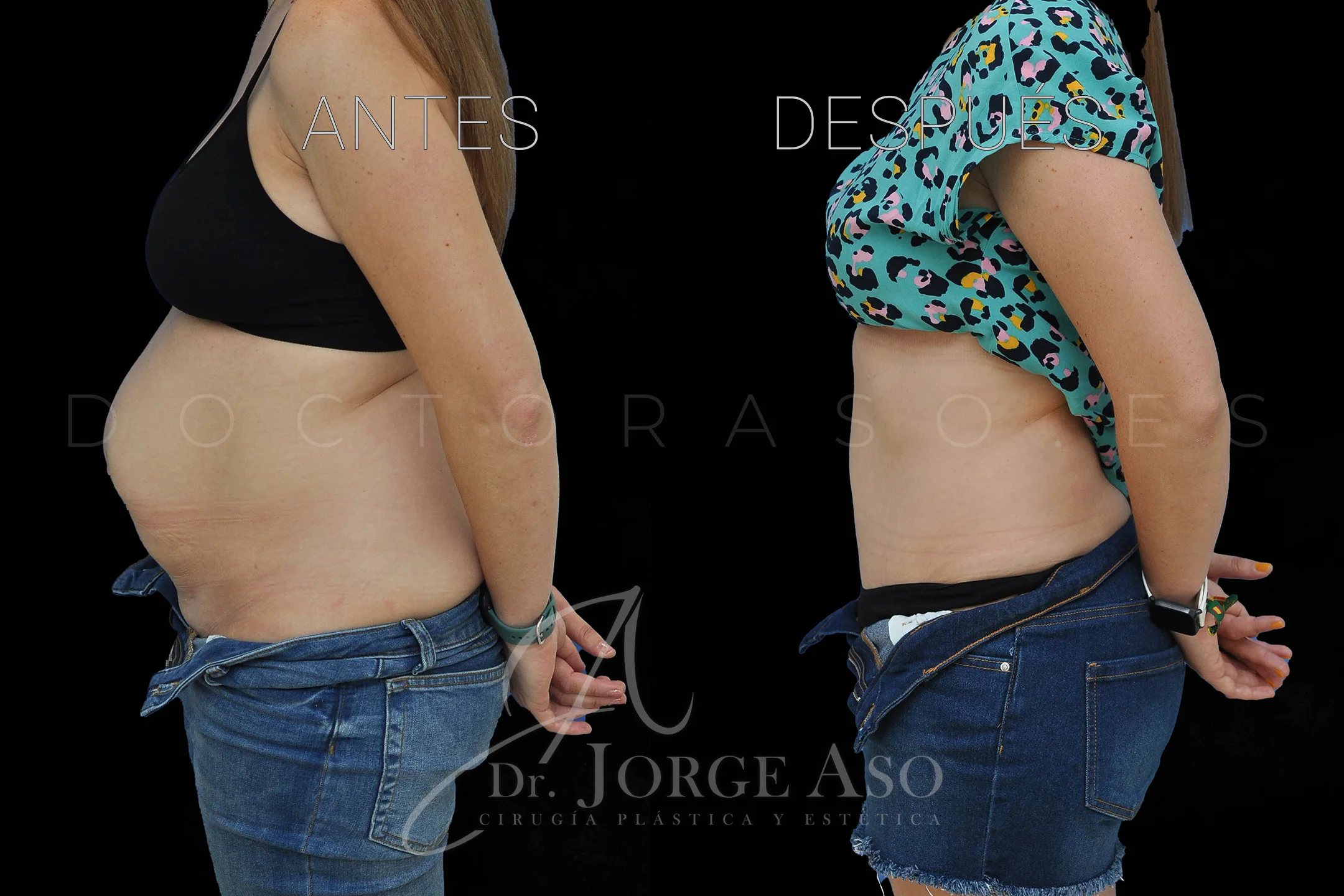 lipoabdominoplastia antes y después con reparación de diástasis de rectos vista lateral