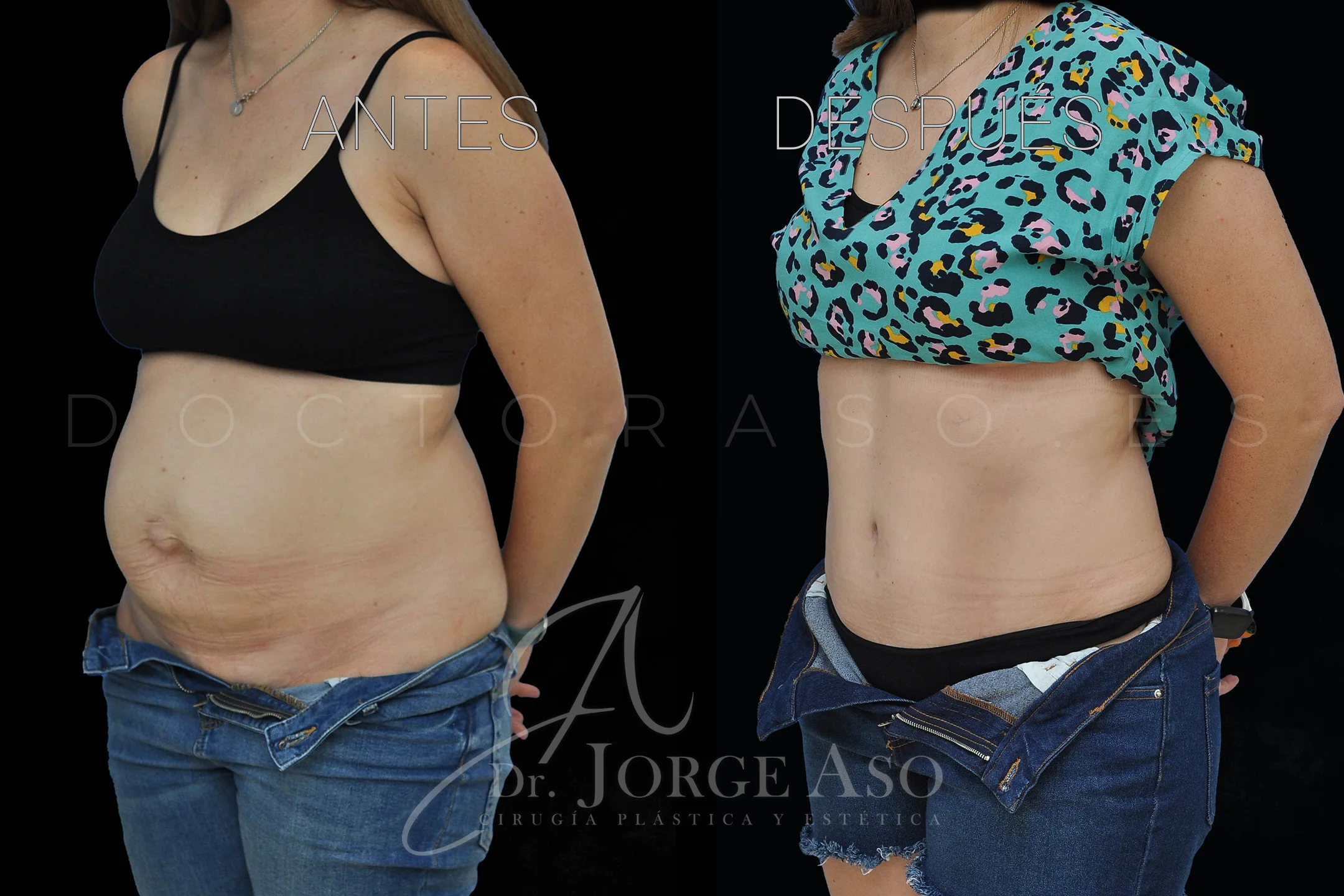 lipoabdominoplastia antes y después con reparación de diástasis de rectos vista oblicua