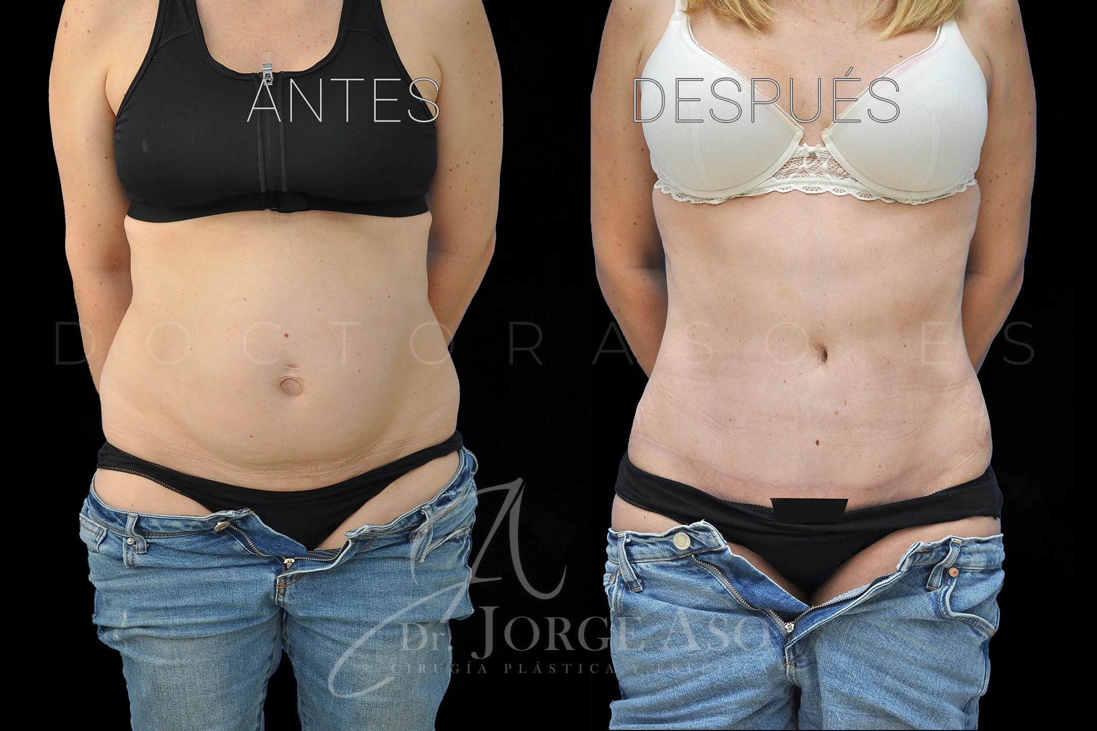 lipoabdominoplastia antes y después con reparación de diástasis de rectos vista frontal