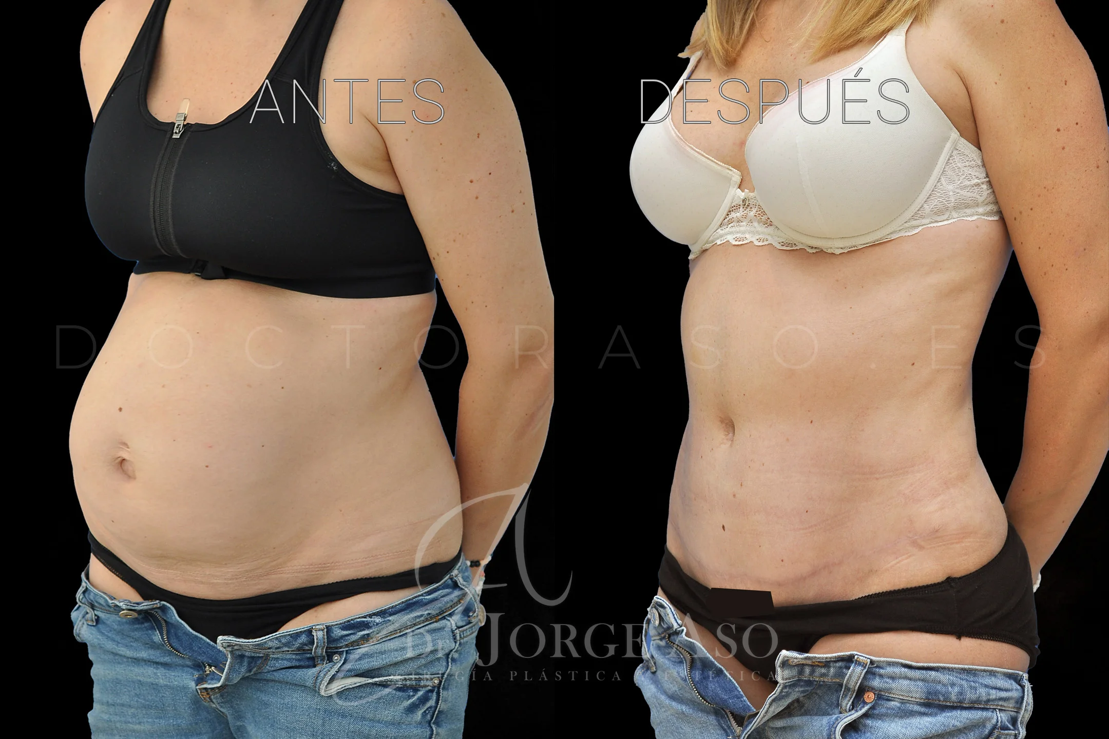 lipoabdominoplastia antes y después con reparación de diástasis de rectos vista oblicua