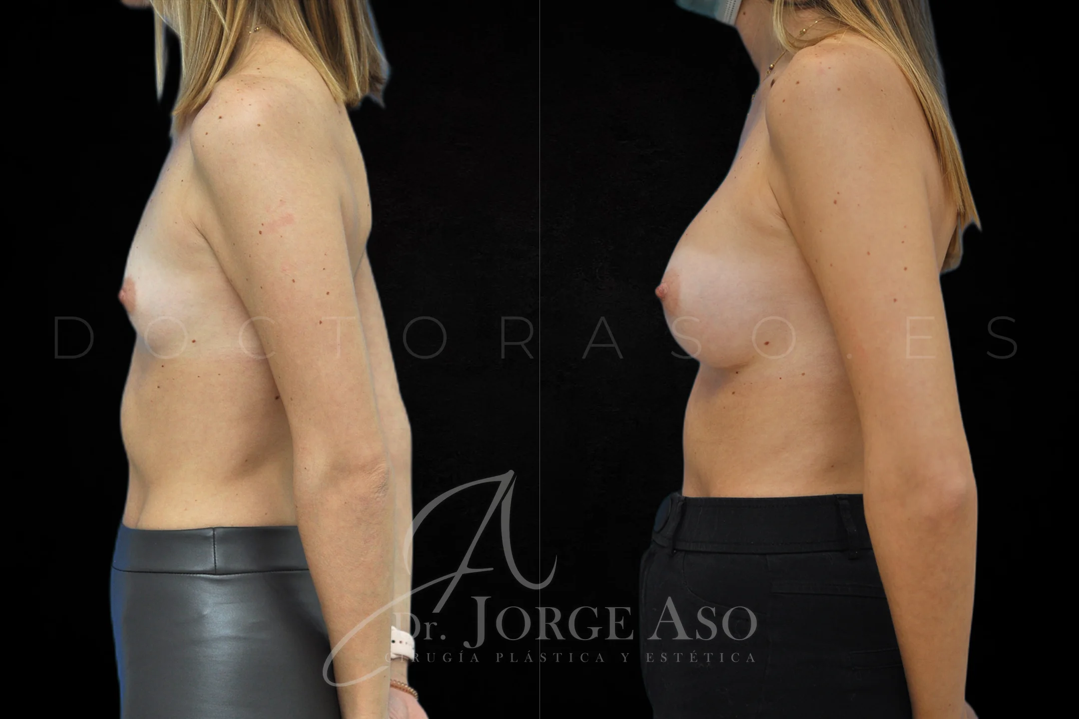Aumento de pecho con protesis Anatómicas de 220 cc perfil Moderado vista lateral