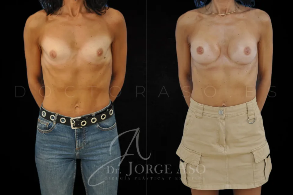Clinical case of breast augmentation with 255 cc anatomical implants, moderate profile, front view, before and after.
