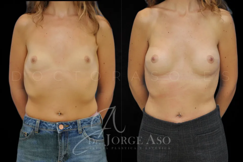Clinical case of breast augmentation with 255 cc anatomical implants, moderate profile, front view, before and after.