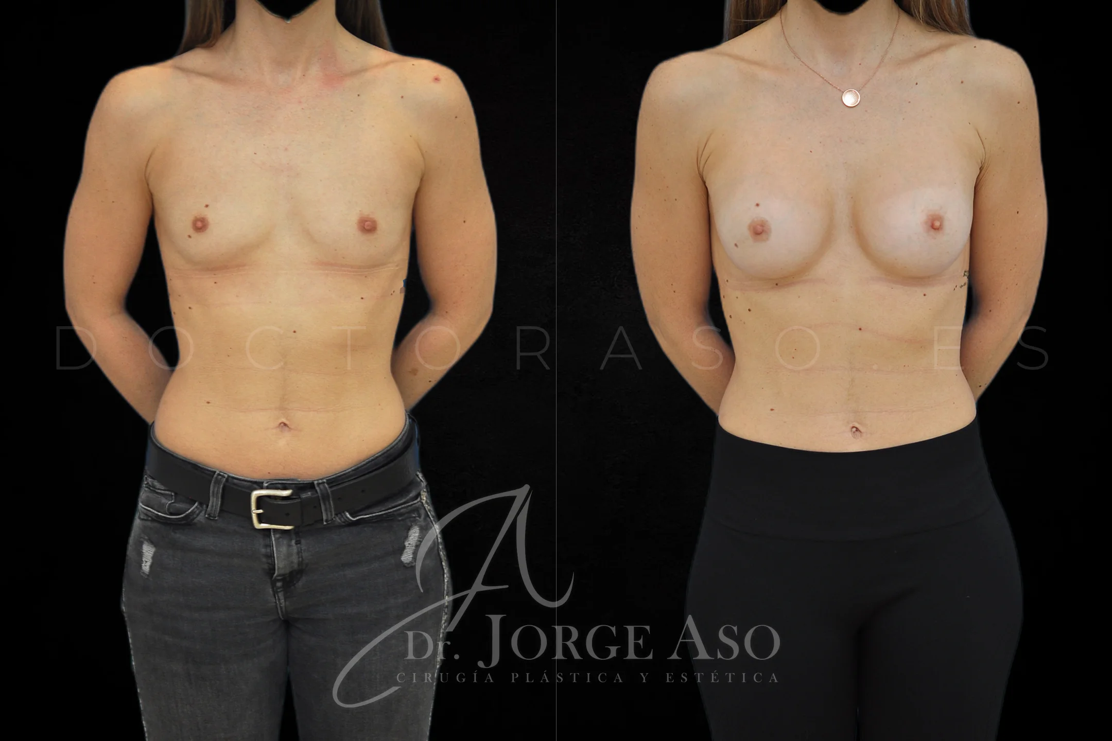 Aumento de pecho con protesis Anatómicas de 255 cc perfil Moderado vista frontal