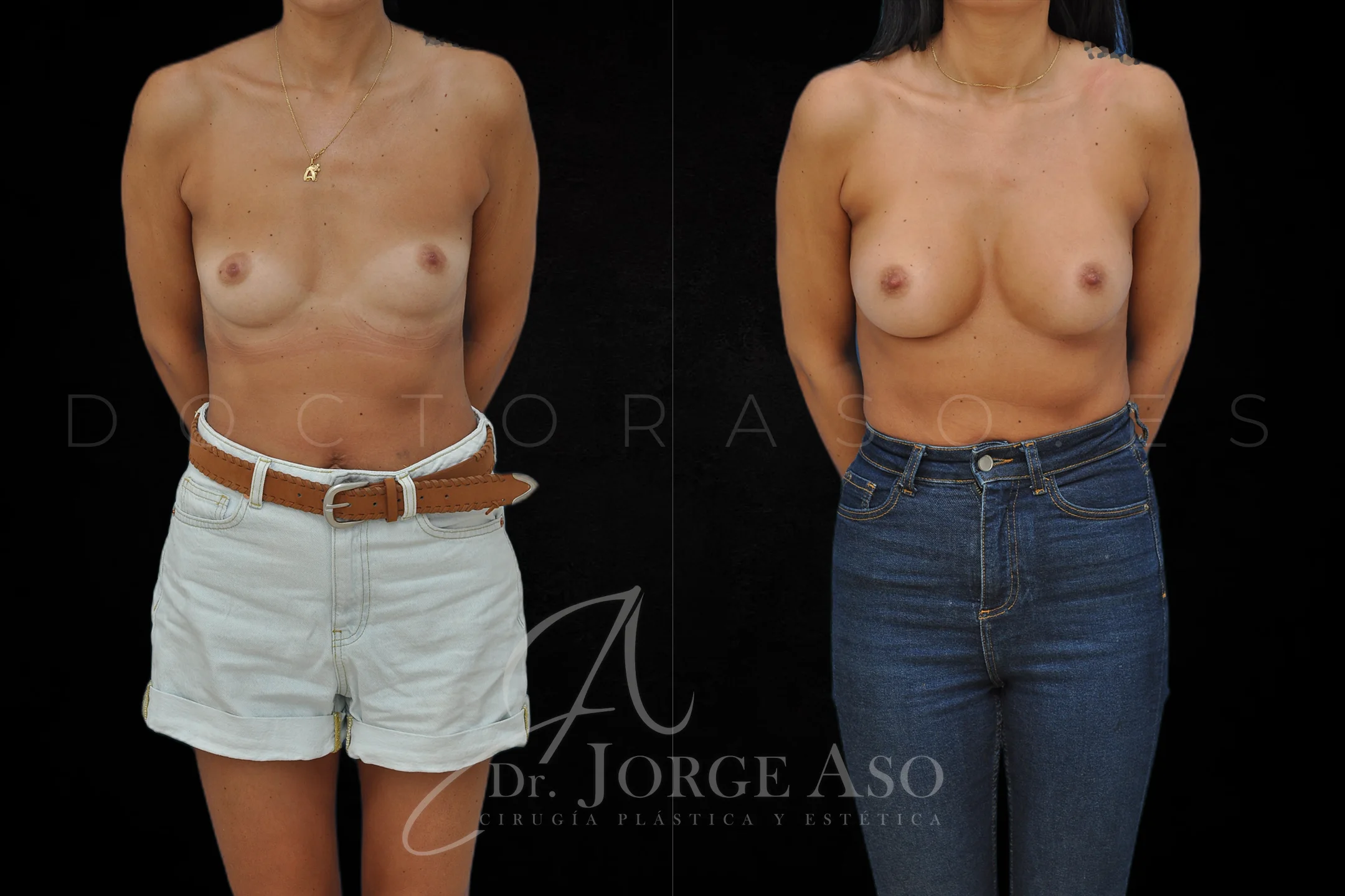Aumento de pecho con protesis Anatómicas de 255 cc perfil Moderado vista frontal