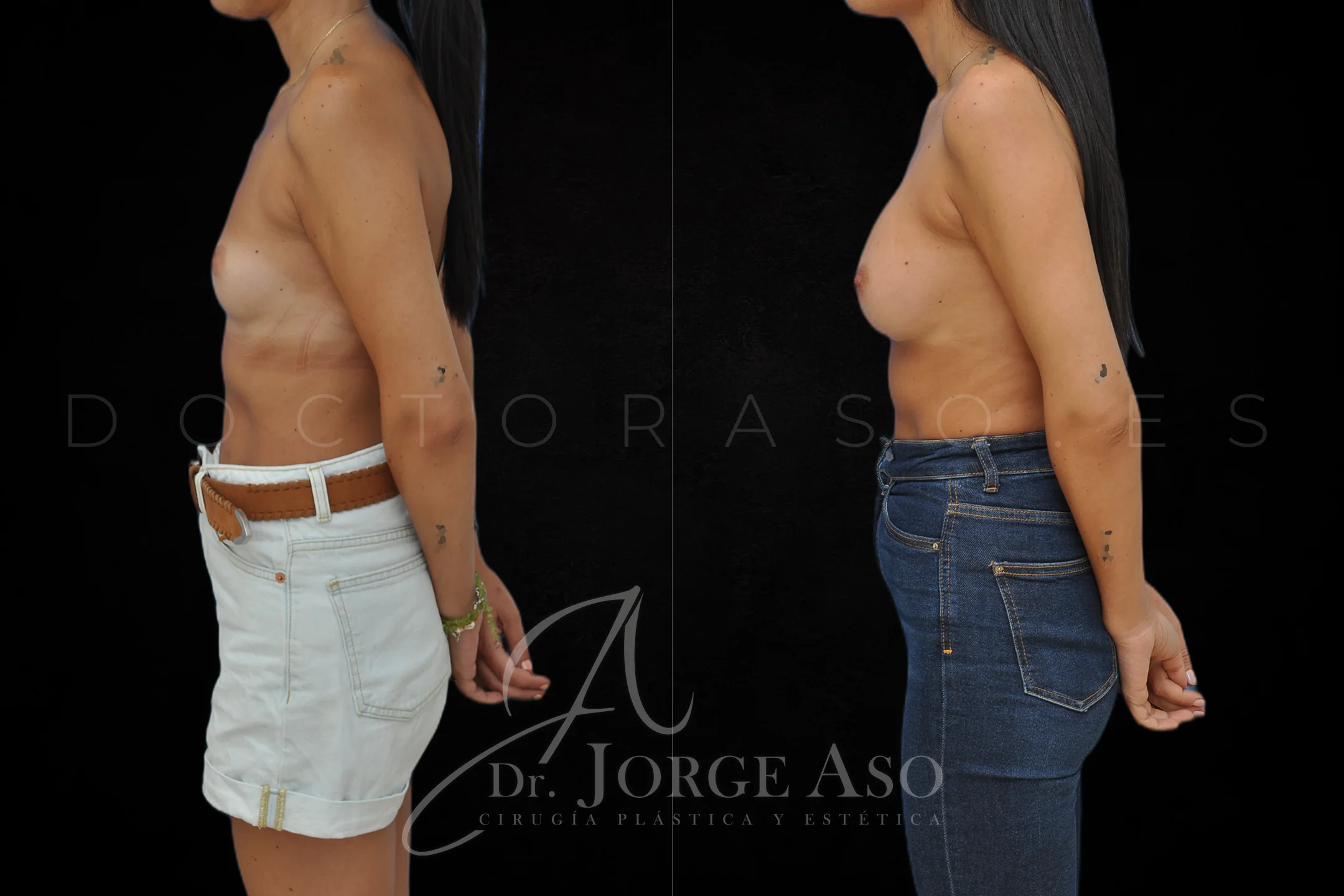 Aumento de pecho con protesis Anatómicas de 255 cc perfil Moderado vista lateral