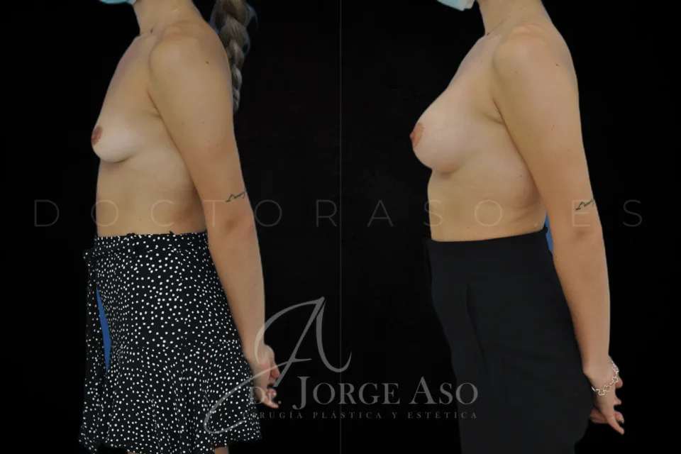 Aumento de pecho antes y después, prótesis anatómicas, 255 cc, perfil moderado, vista lateral