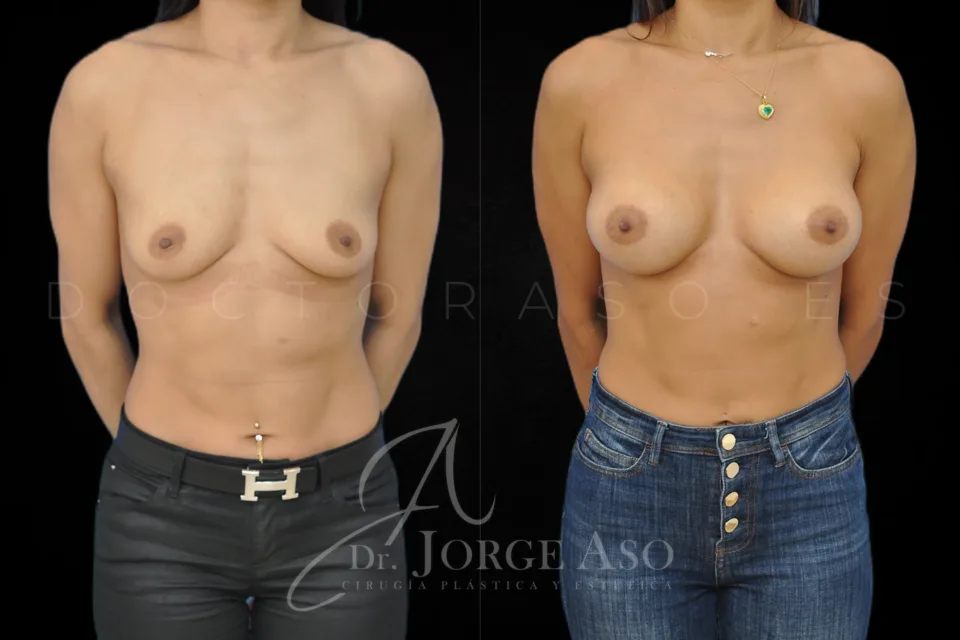 Clinical case of breast augmentation with 265 cc anatomical implants, high profile, front view, before and after.