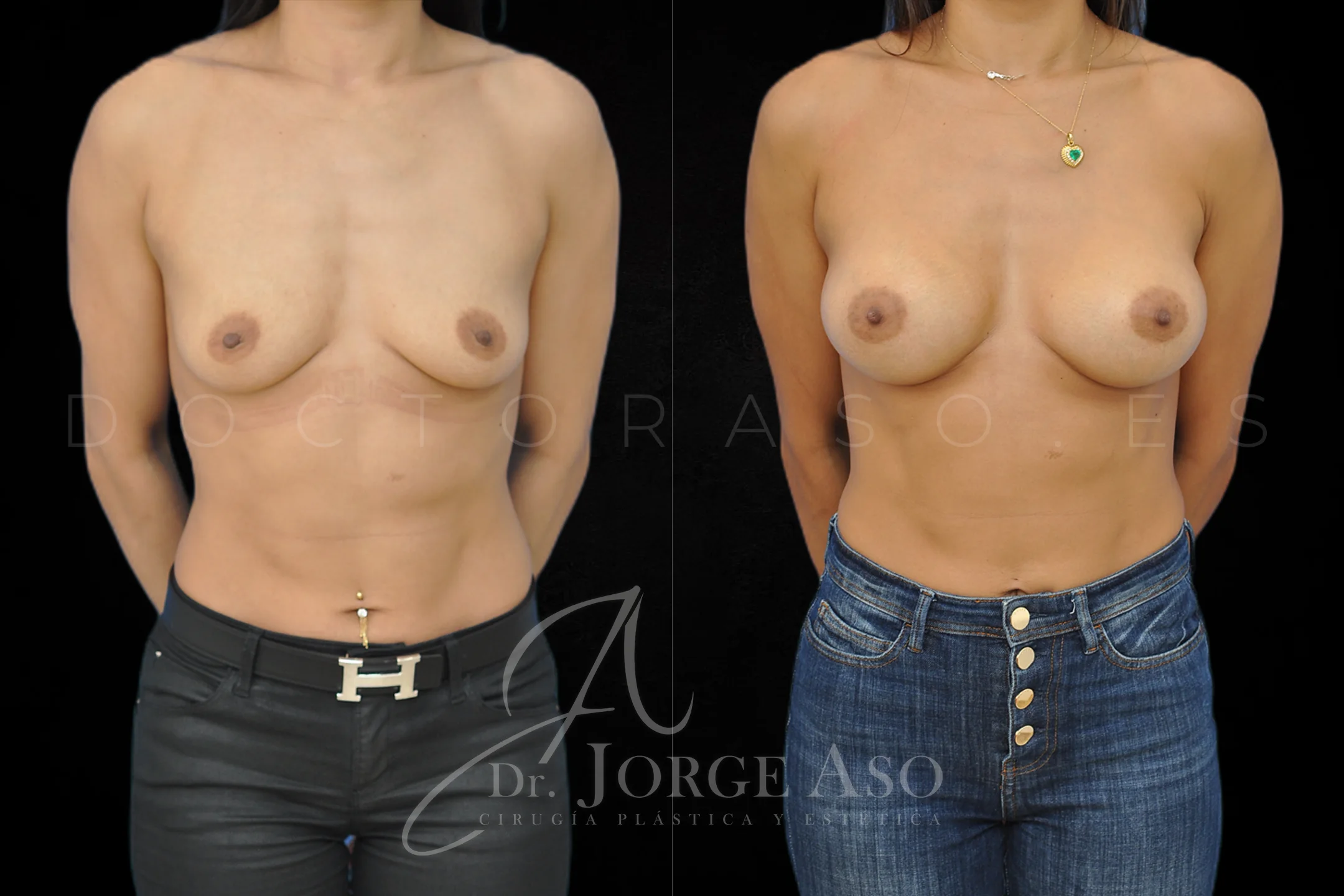 Aumento de pecho con protesis Anatómicas de 265 cc perfil Alto vista frontal