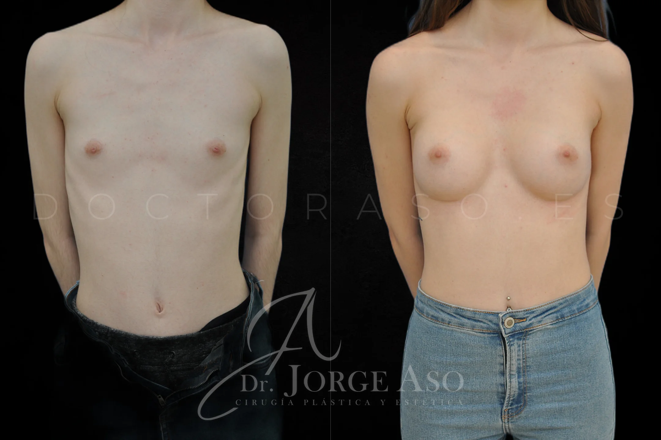 Aumento de pecho con protesis Anatómicas de 290 cc perfil Extra alto vista frontal