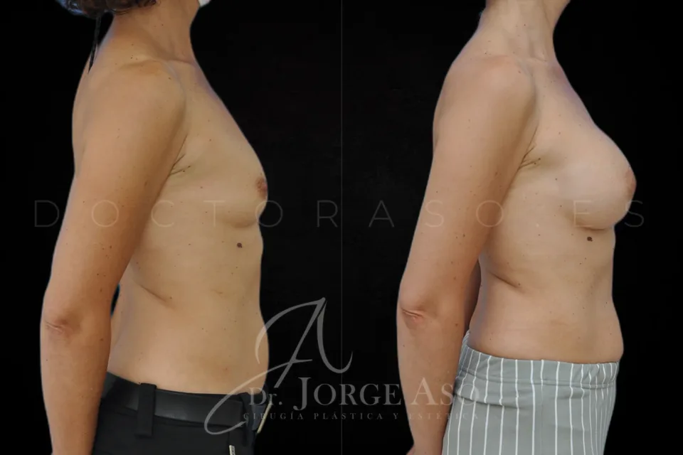 Aumento de pecho antes y después, prótesis anatómicas, 315 cc, perfil alto, vista lateral