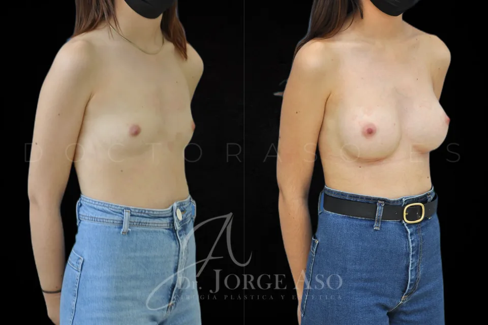Aumento de pecho antes y después, prótesis anatómicas, 315 cc, perfil alto, vista oblicua