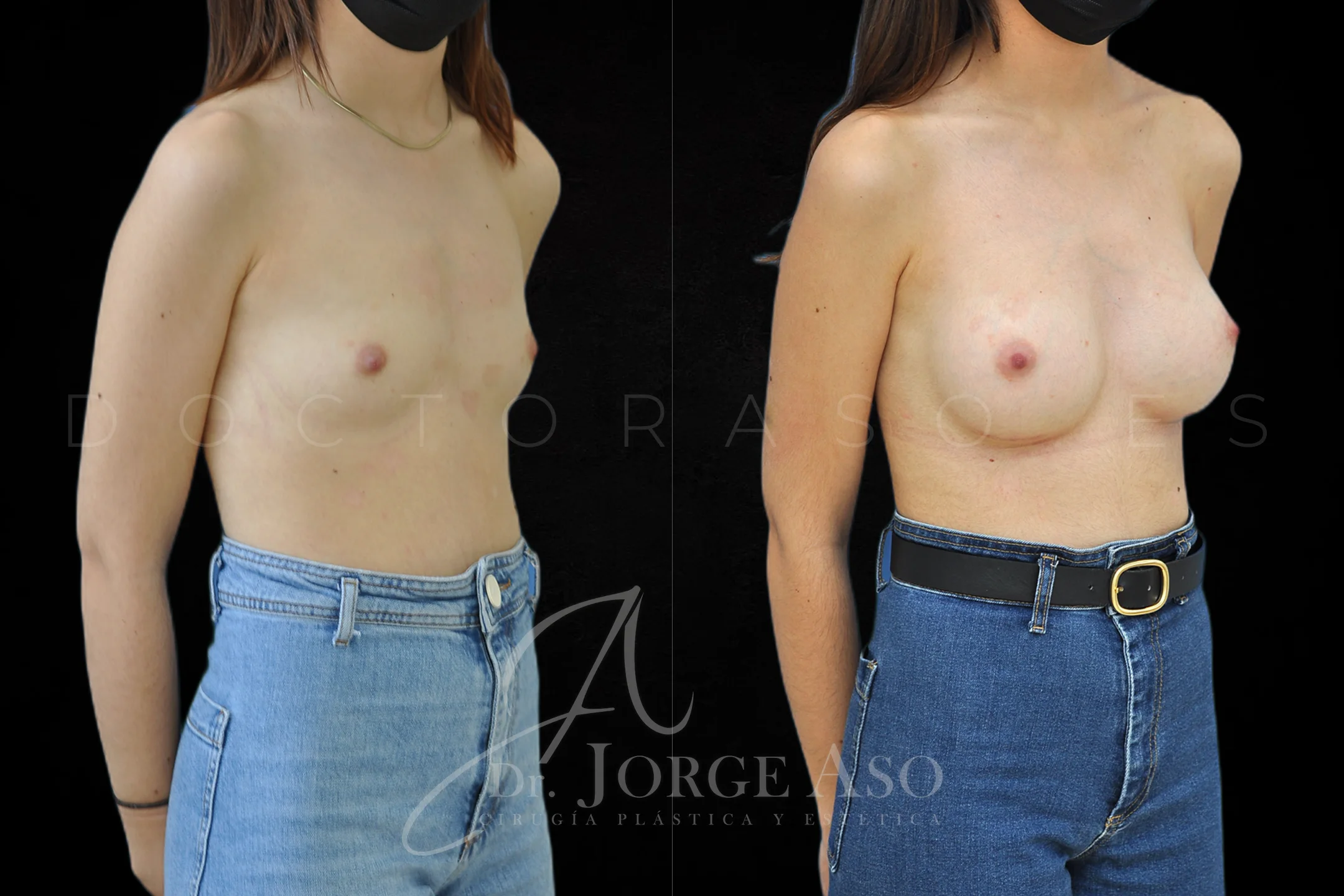 Aumento de pecho con protesis Anatómicas de 315 cc perfil Alto vista oblicua