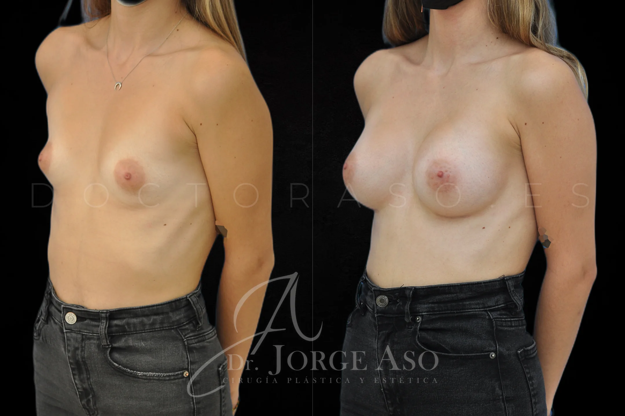 Aumento de pecho con protesis Anatómicas de 315 cc perfil Alto vista oblicua