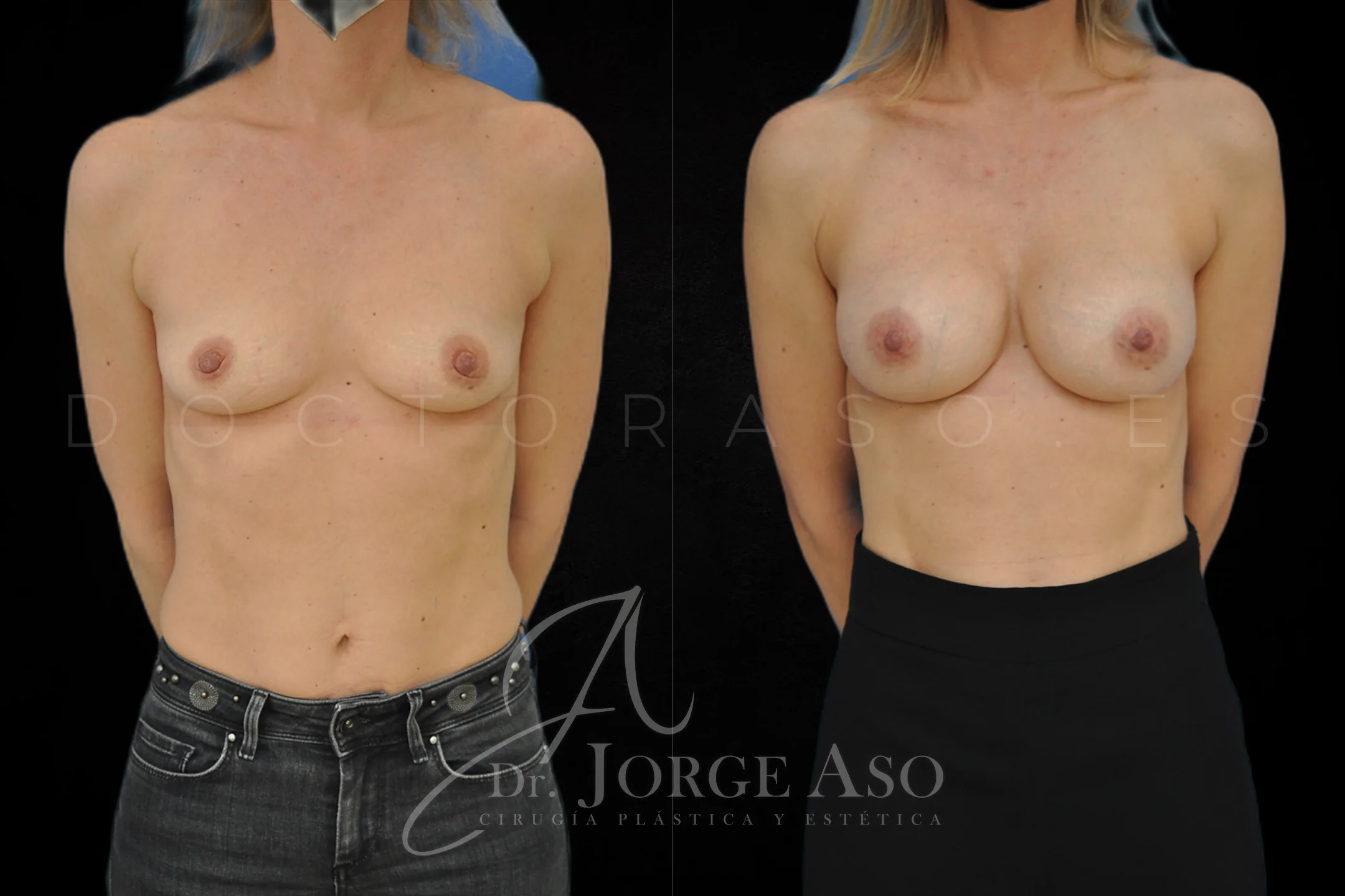 Aumento de pecho con protesis Anatómicas de 315 cc perfil Alto vista frontal