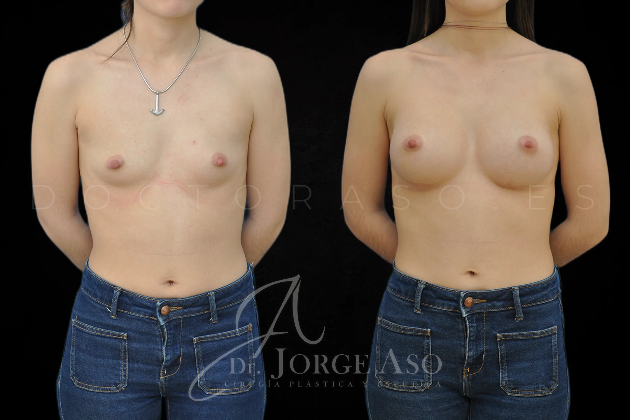 Aumento de pecho con protesis Anatómicas de 315 cc perfil Alto vista frontal