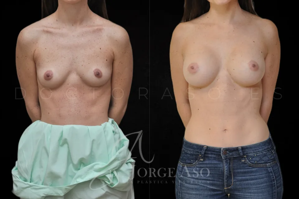 Aumento de pecho antes y después, prótesis anatómicas, 330 cc, perfil alto, vista frontal
