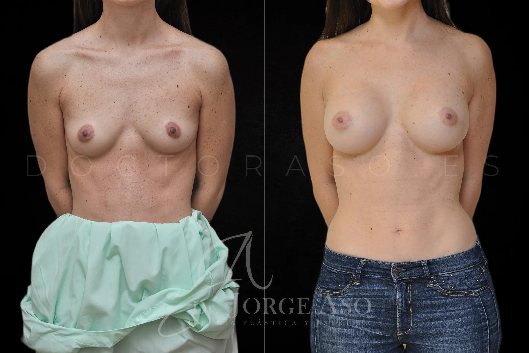 Aumento de pecho con protesis Anatómicas de 330 cc perfil Alto vista frontal
