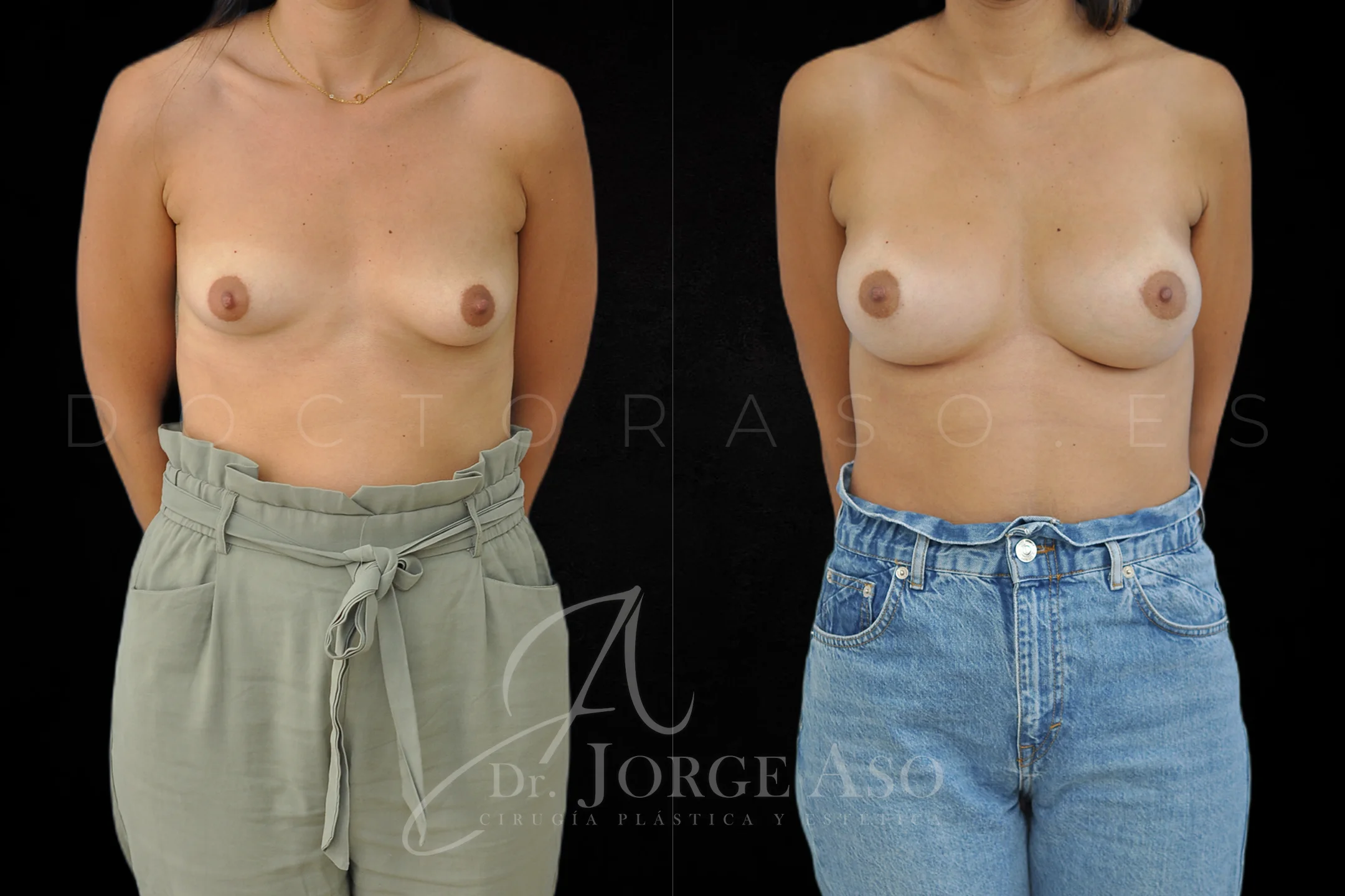 Aumento de pecho con protesis Anatómicas de 335 cc perfil Alto vista frontal