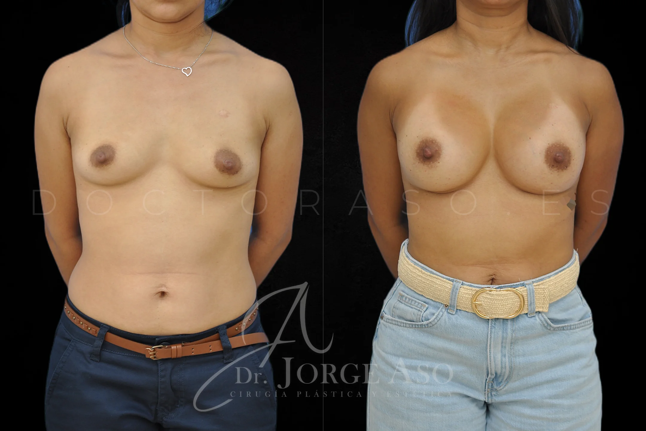 Aumento de pecho con protesis Anatómicas de 350 cc perfil Alto vista frontal
