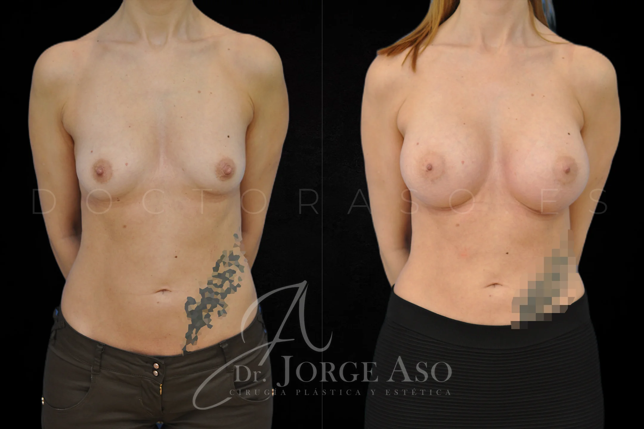 Aumento de pecho con protesis Anatómicas de 350 cc perfil Alto vista frontal