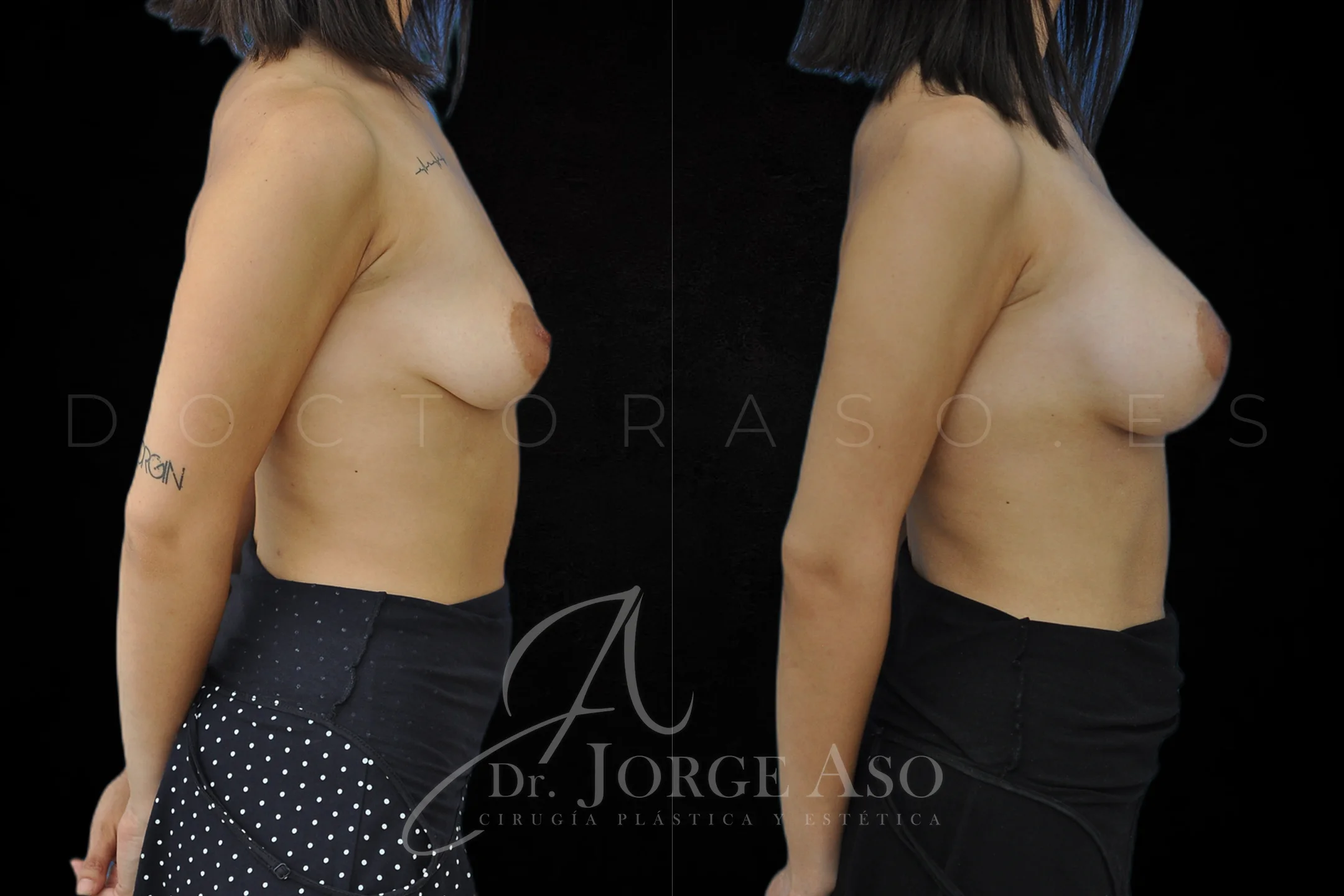 Aumento de pecho con protesis Anatómicas de 350 cc perfil Alto vista lateral