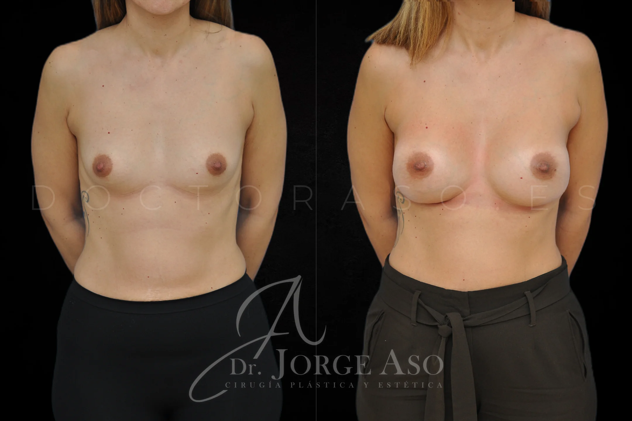 Aumento de pecho con protesis Anatómicas de 350 cc perfil Alto vista frontal