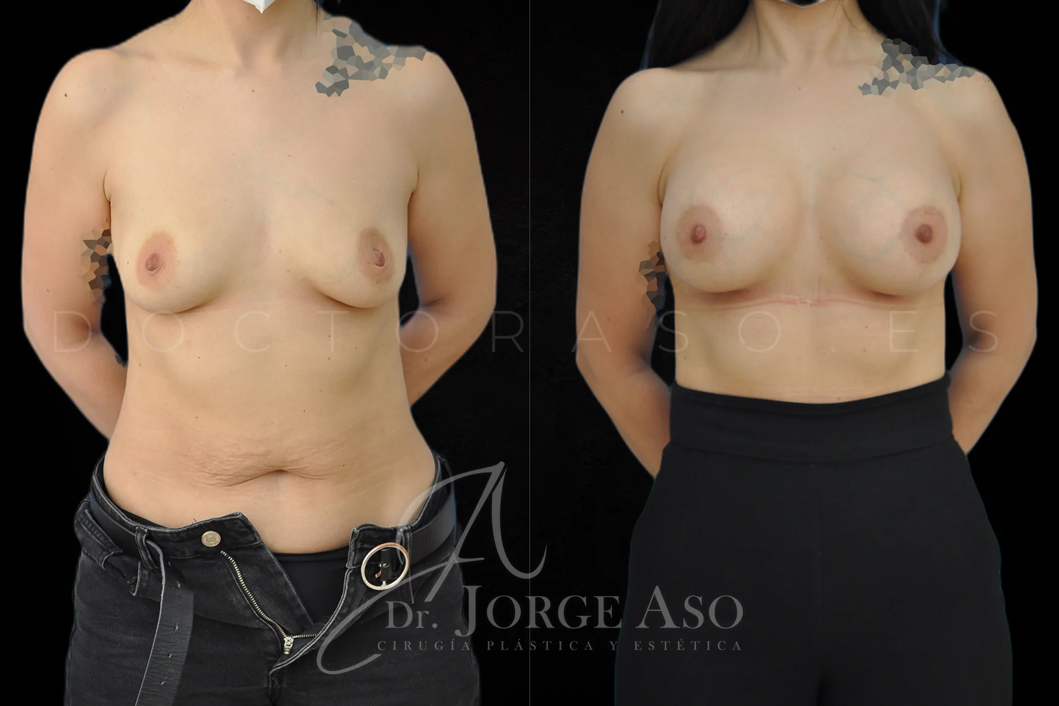 Aumento de pecho con protesis Anatómicas de 350 cc perfil Alto vista frontal