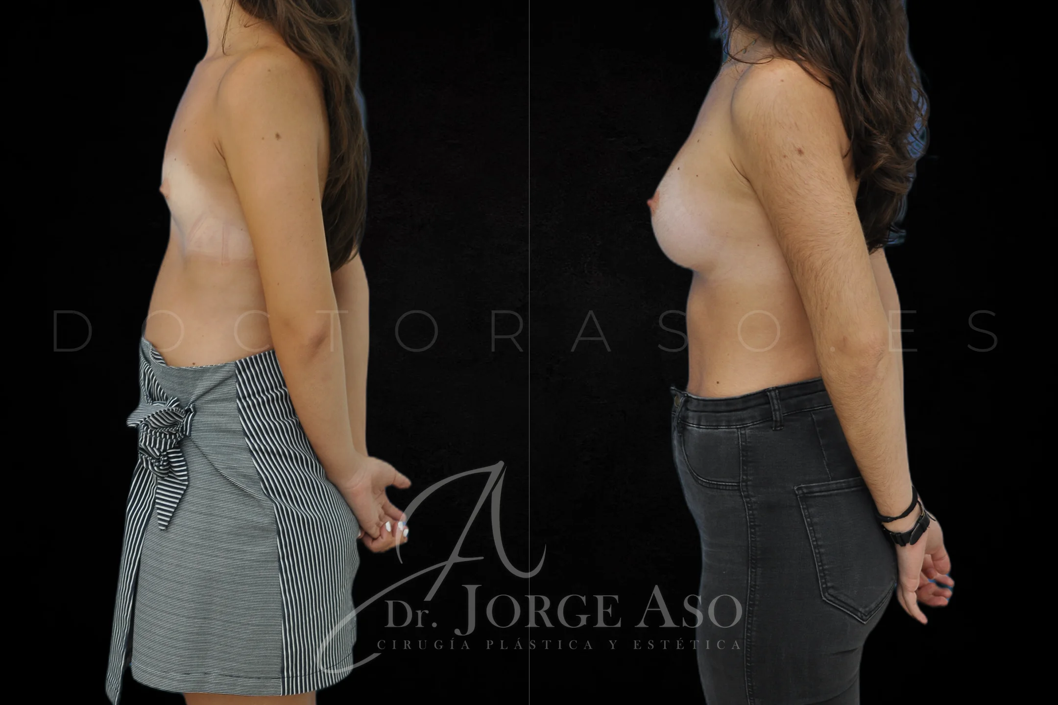 Aumento de pecho con protesis Anatómicas de 350 cc perfil Alto vista lateral