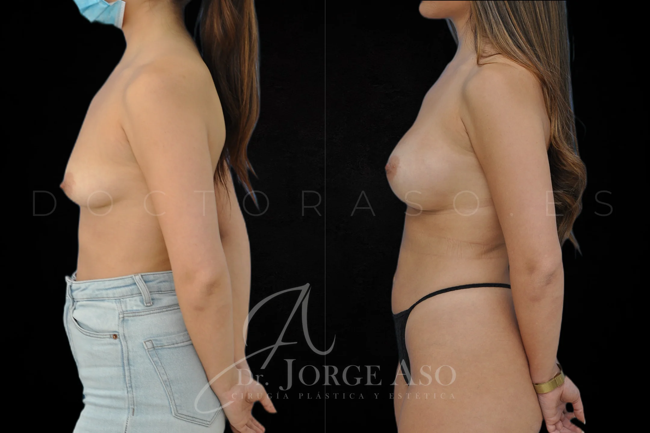 Aumento de pecho con protesis Anatómicas de 350 cc perfil Alto vista lateral