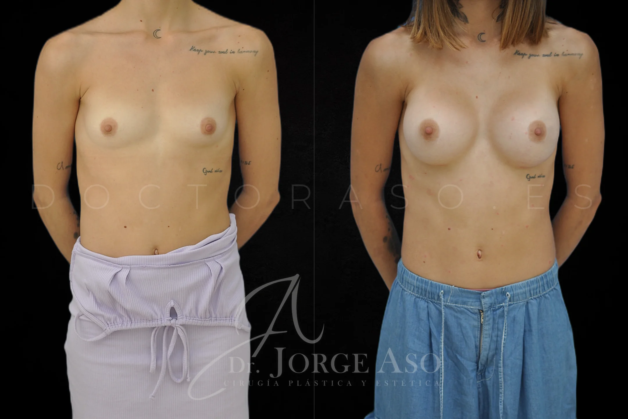 Aumento de pecho con protesis Anatómicas de 380 cc perfil Extra alto vista frontal
