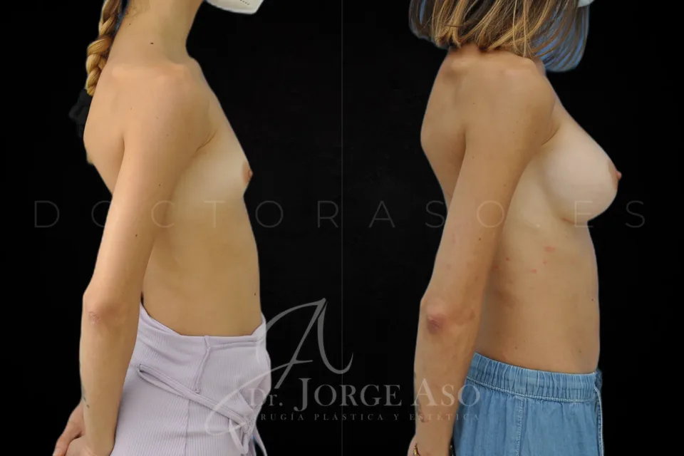 Aumento de pecho antes y después, prótesis anatómicas, 380 cc, perfil extra alto, vista lateral