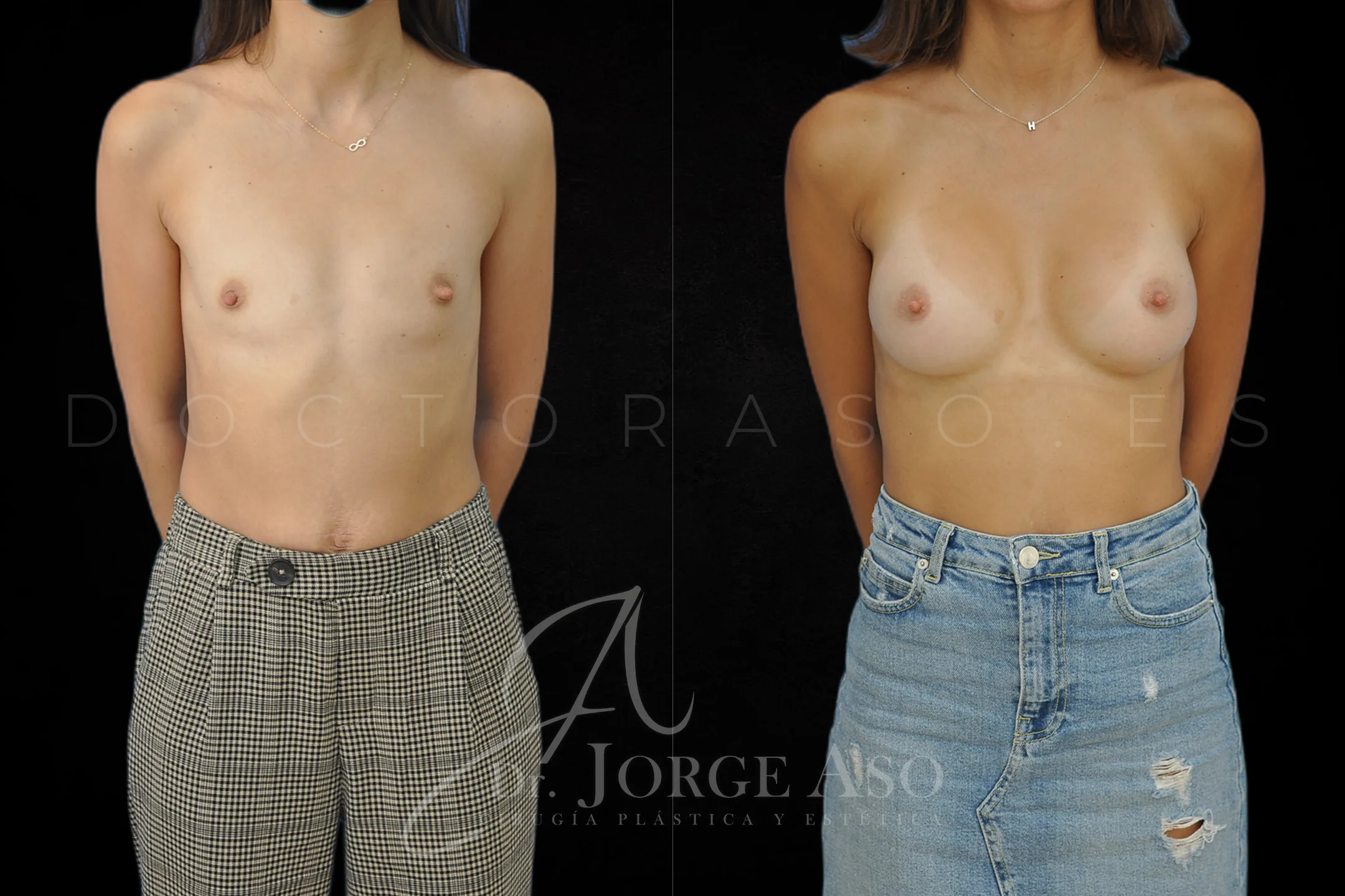 Aumento de pecho con protesis Anatómicas de 380 cc perfil Extra alto vista frontal