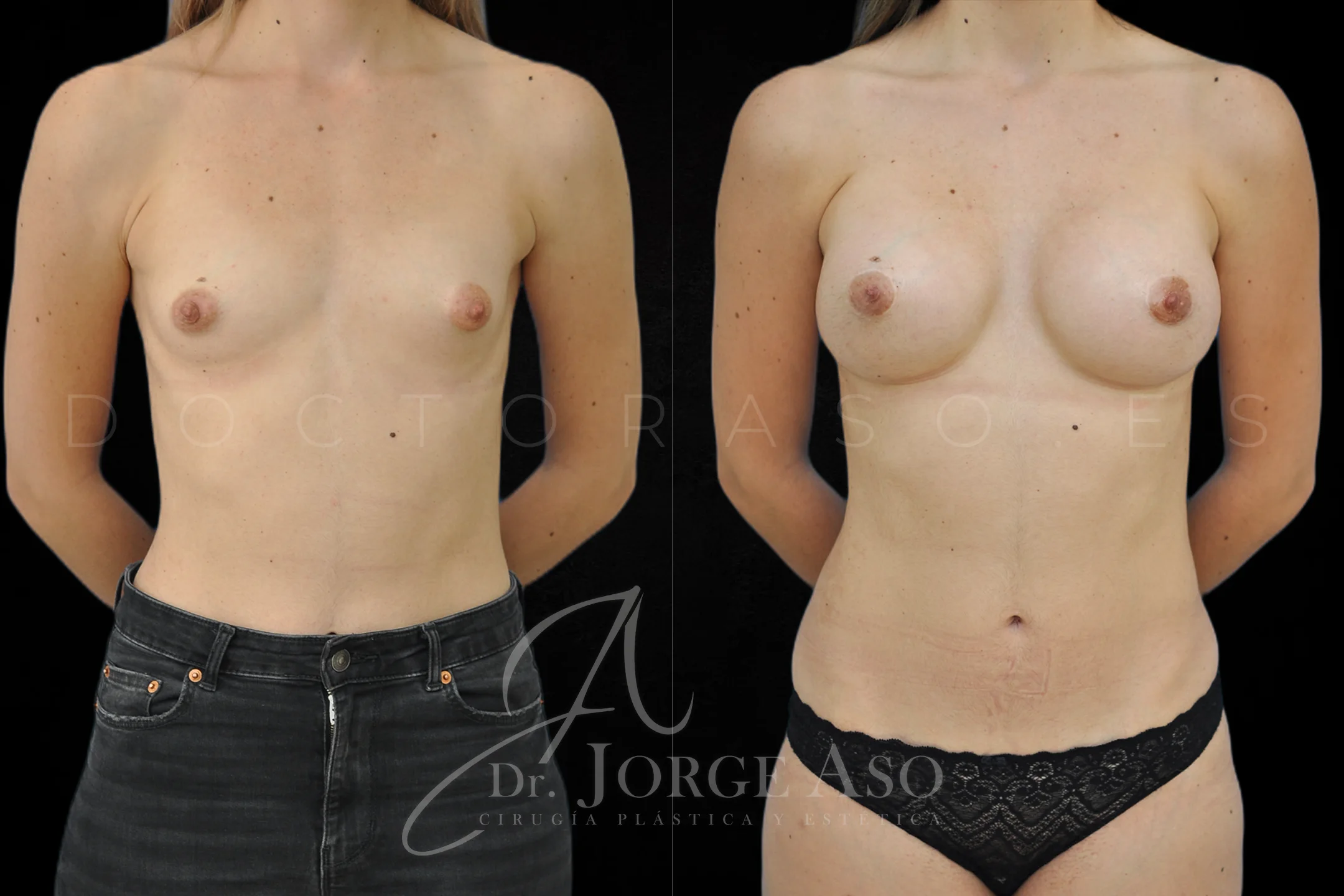 Aumento de pecho con protesis Anatómicas de 395 cc perfil Alto vista frontal