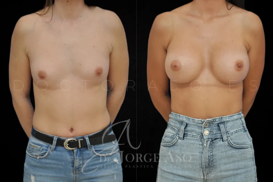 Aumento de pecho antes y después, prótesis anatómicas, 395 cc, perfil alto, vista frontal