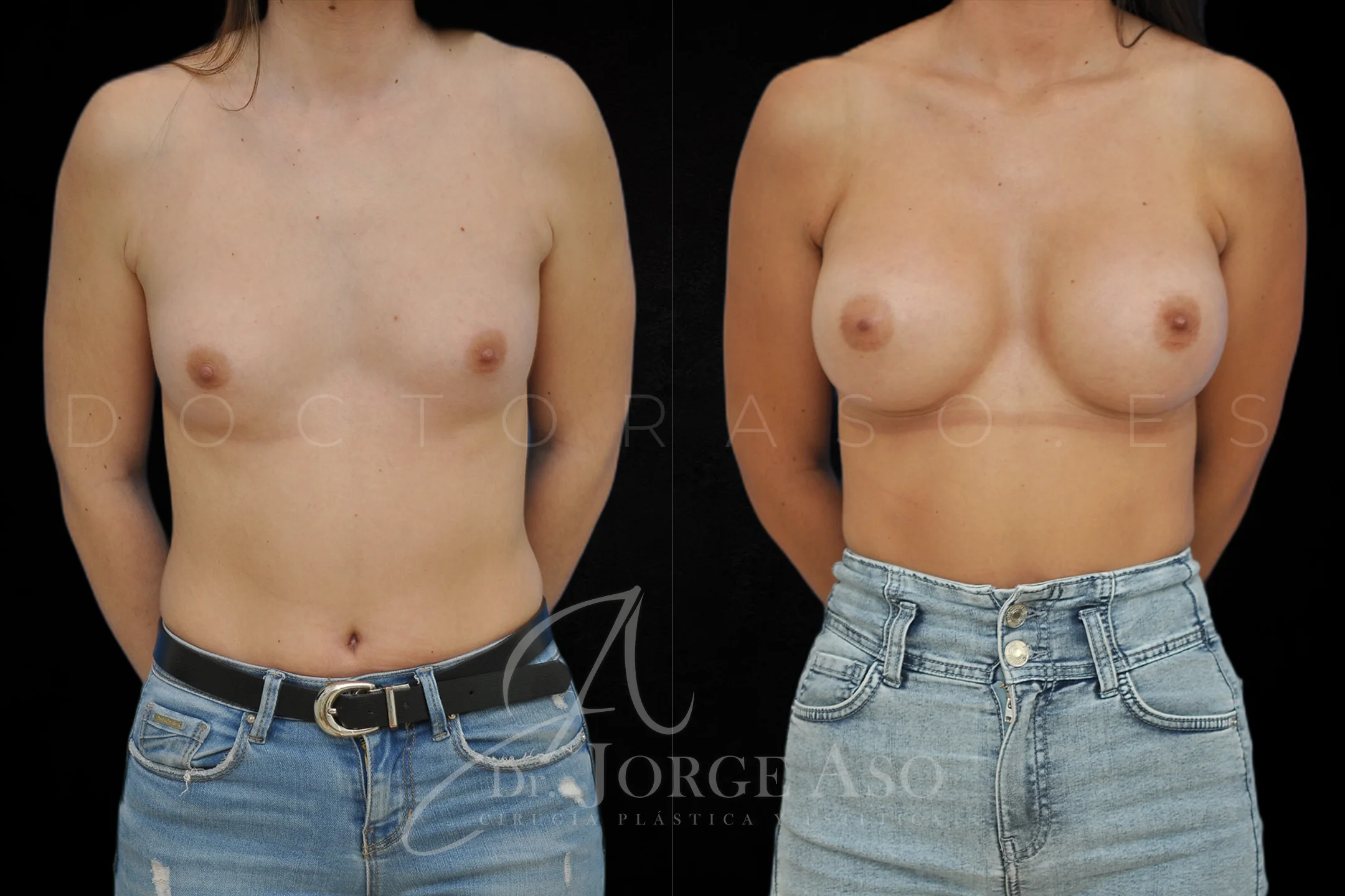 Aumento de pecho con protesis Anatómicas de 395 cc perfil Alto vista frontal