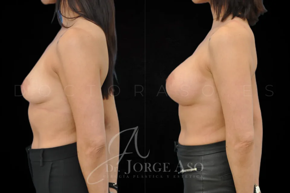 Aumento de pecho antes y después, prótesis anatómicas, 395 cc, perfil alto, vista lateral