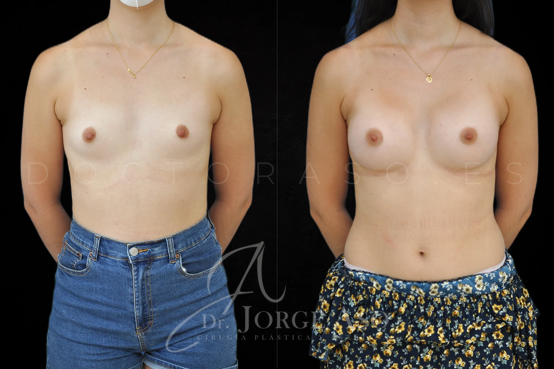 Aumento de pecho con protesis Anatómicas de 395 cc perfil Alto vista frontal