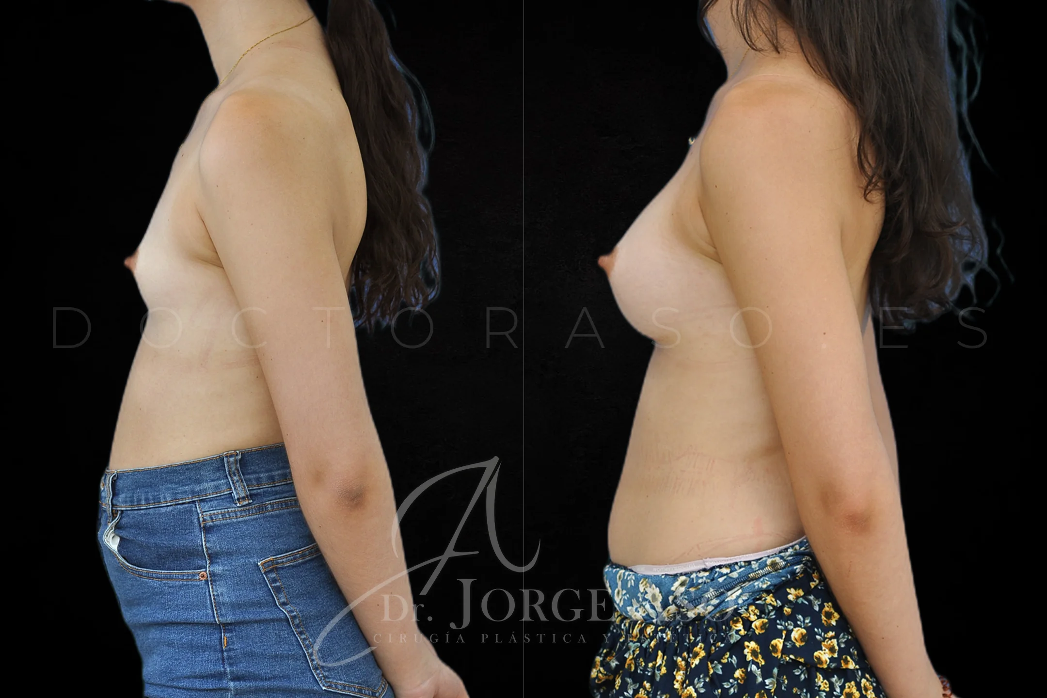 Aumento de pecho con protesis Anatómicas de 395 cc perfil Alto vista lateral