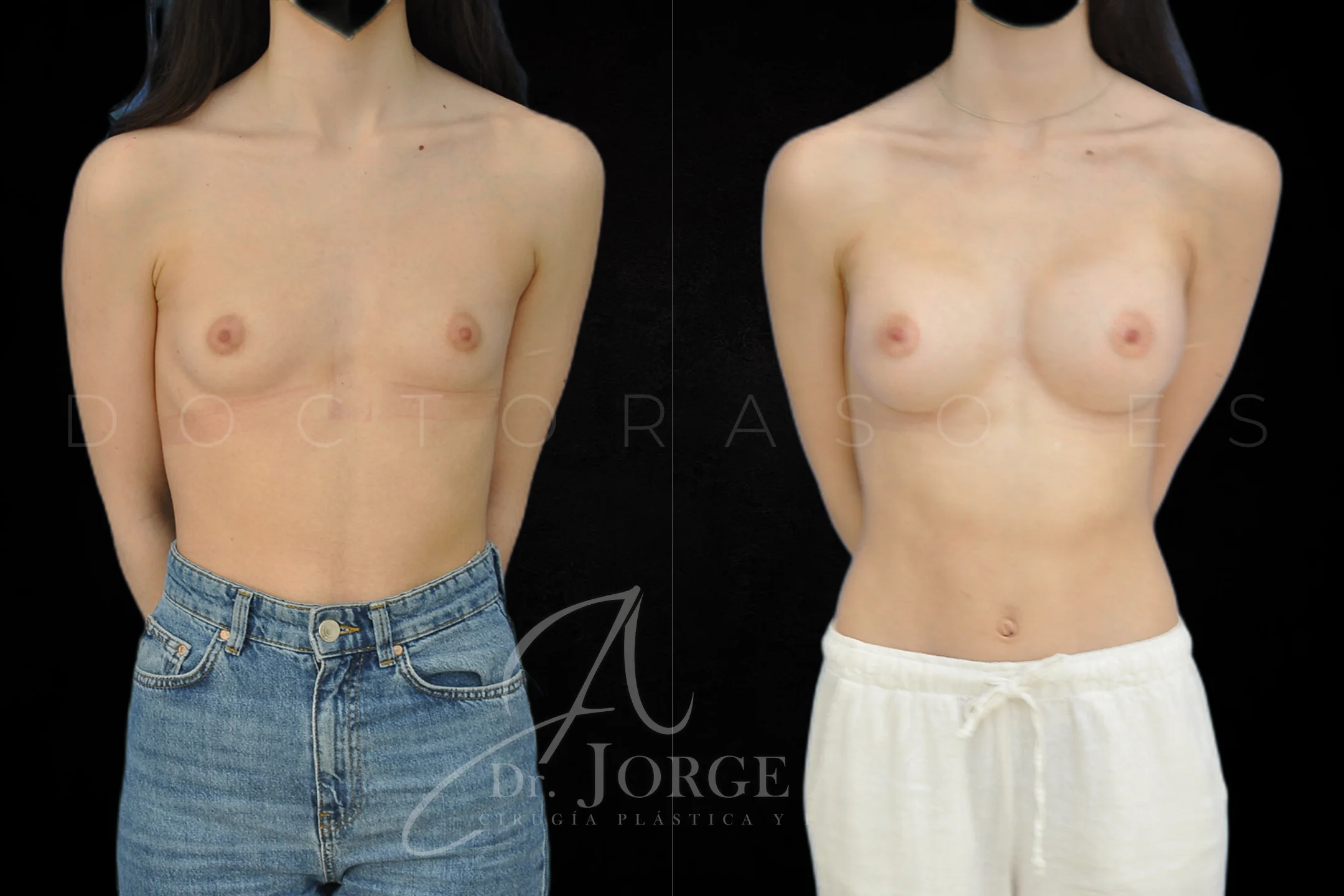 Aumento de pecho con protesis Anatómicas de 395 cc perfil Alto vista frontal