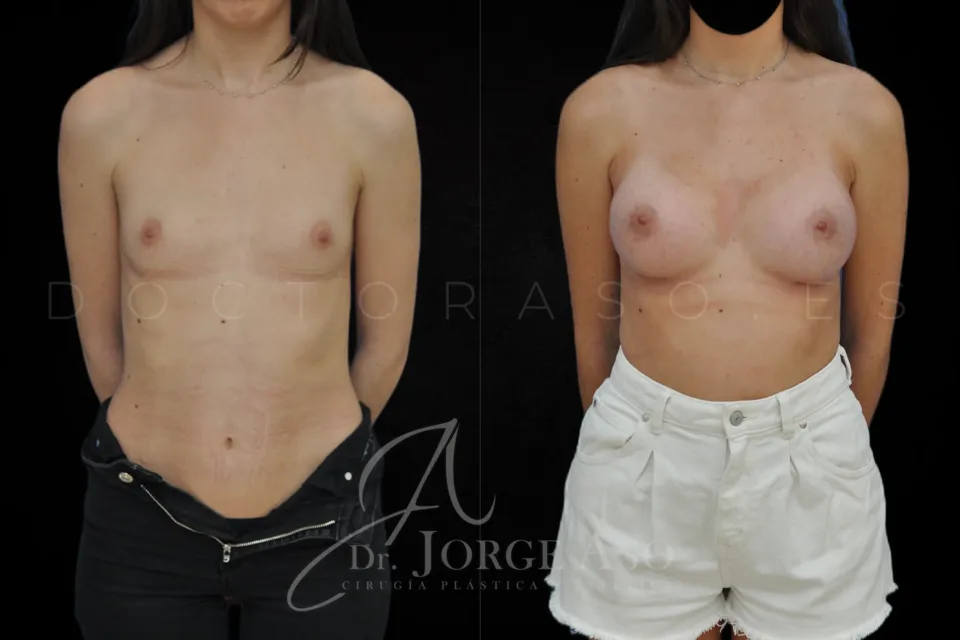 Aumento de pecho antes y después, prótesis anatómicas, 395 cc, perfil alto, vista frontal