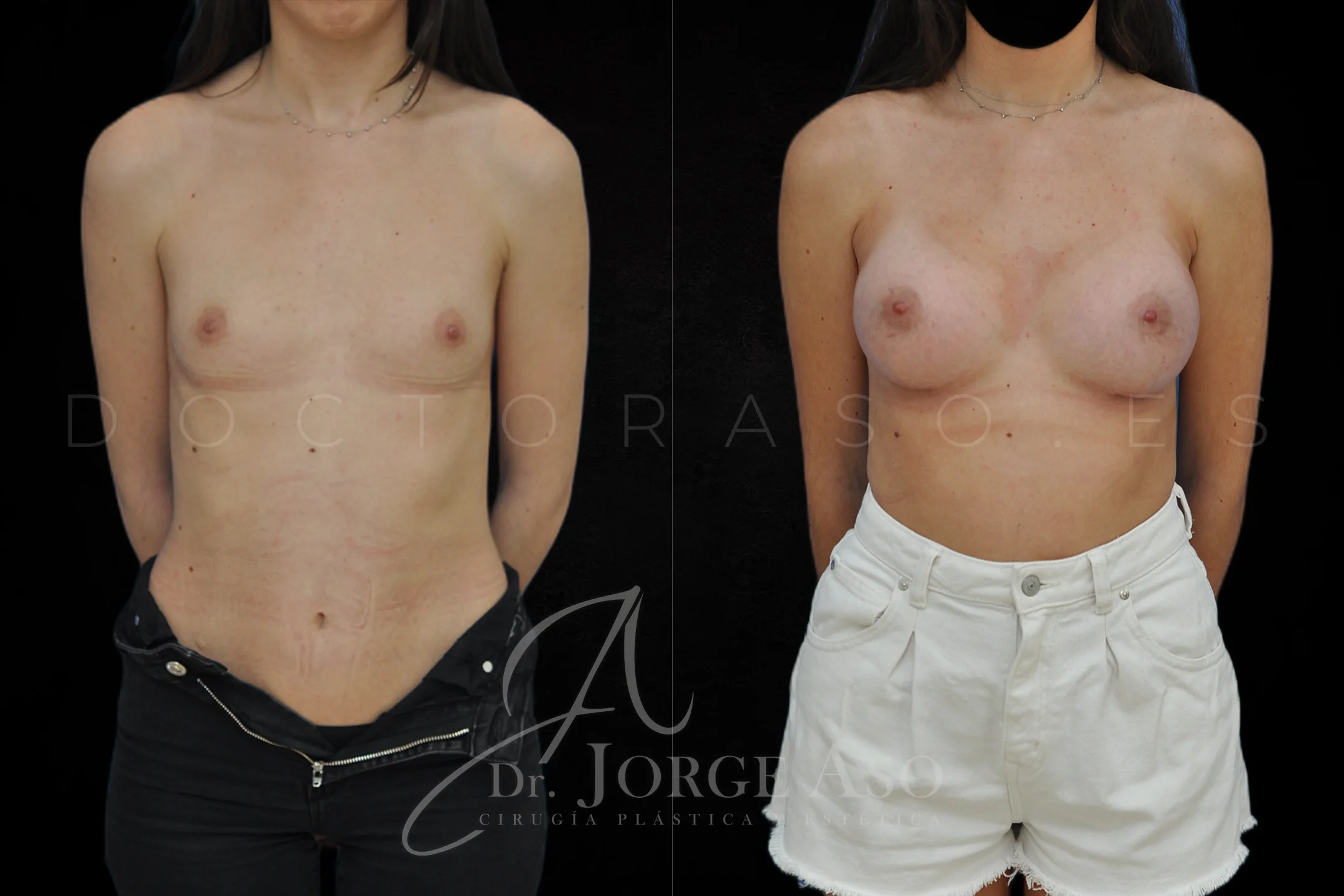 Aumento de pecho con protesis Anatómicas de 395 cc perfil Alto vista frontal