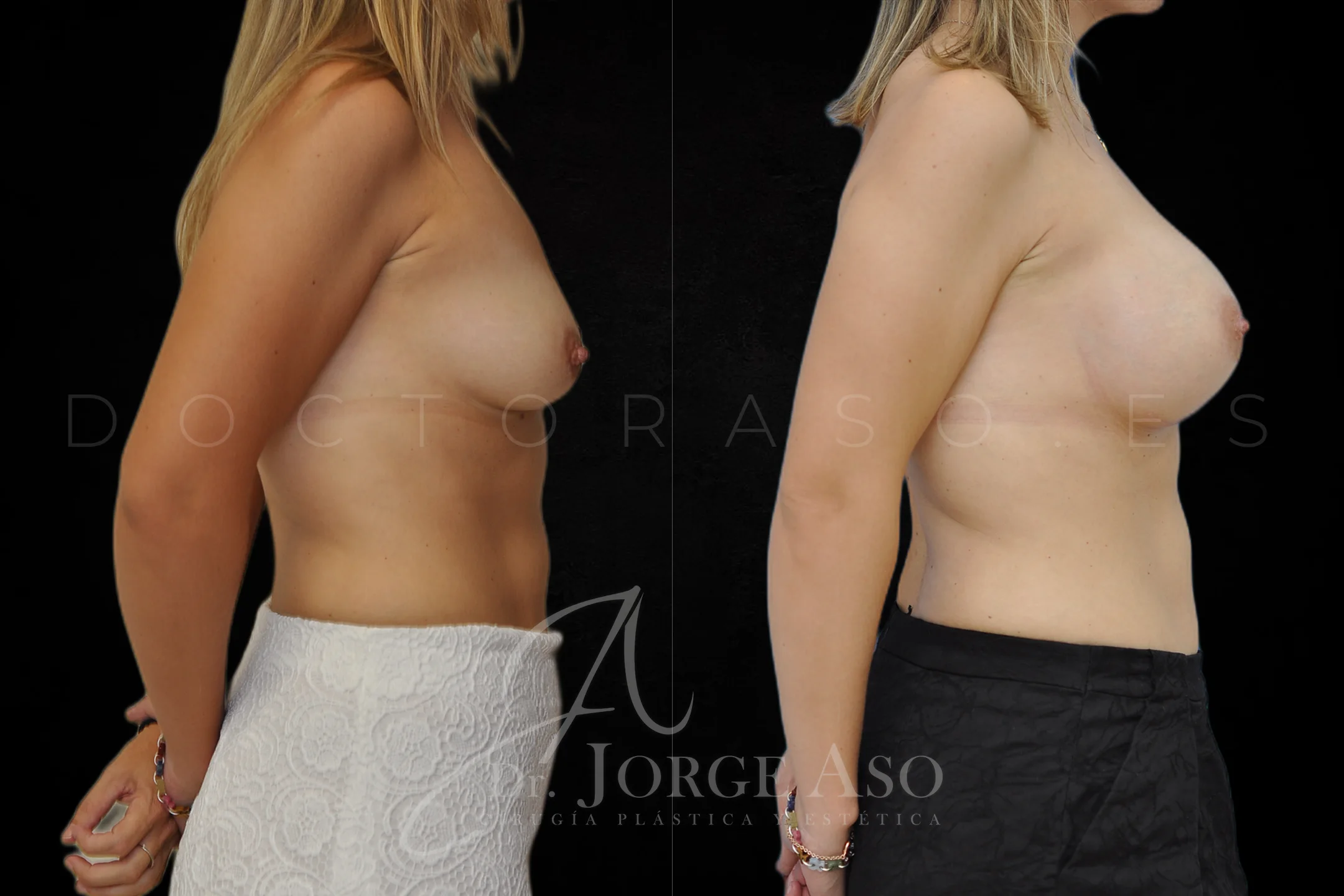 Aumento de pecho con protesis Anatómicas de 395 cc perfil Alto vista lateral
