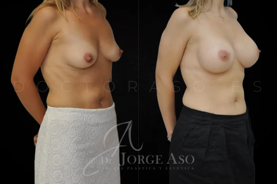 Aumento de pecho antes y después, prótesis anatómicas, 395 cc, perfil alto, vista oblicua