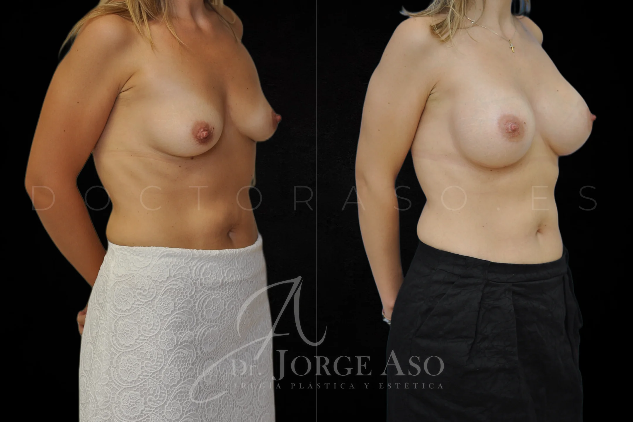 Aumento de pecho con protesis Anatómicas de 395 cc perfil Alto vista oblicua