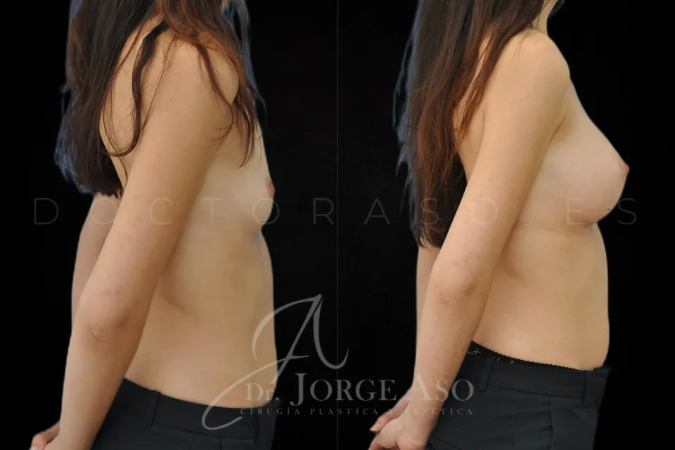 Aumento de pecho antes y después, prótesis anatómicas, 395 cc, perfil alto, vista lateral