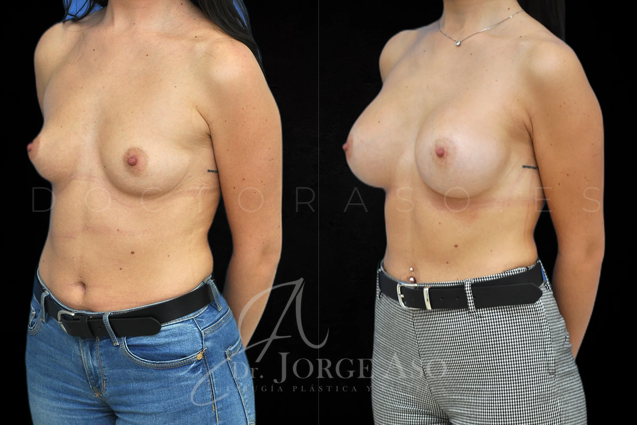 Aumento de pecho con protesis Anatómicas de 400 cc perfil Alto vista oblicua