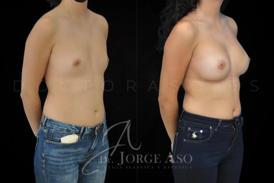 Aumento de pecho antes y después, prótesis anatómicas, 425 cc, perfil alto, vista oblicua