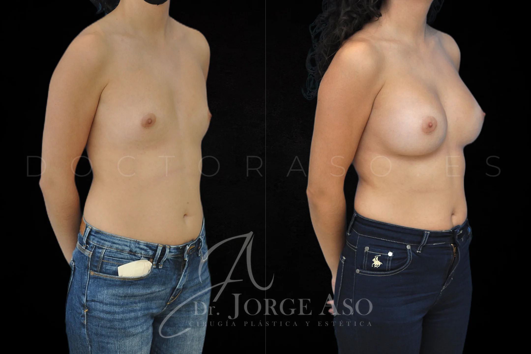 Aumento de pecho con protesis Anatómicas de 425 cc perfil Alto vista oblicua